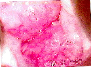 infecci�n uterina