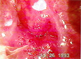 disfunci�n uterina cr�nica