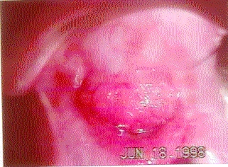 infecci�n uterina