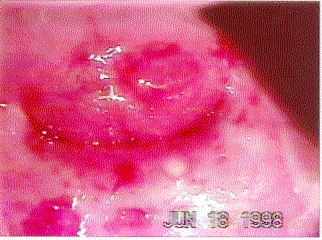 tratamiento contra el s�ndrome premenstrual