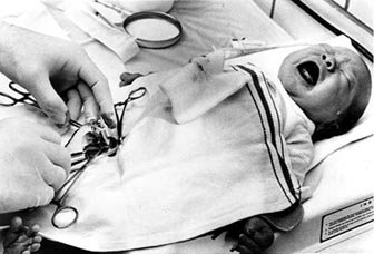 Baby boy experiencing excruciating pain during circumcision without a general or local anaesthesia