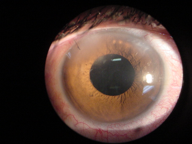 Primer d�a postoperatorio de facoemulsificaci�n