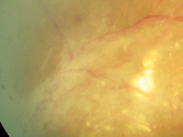 Bandas fibrosas por Retinopat�a diab�tica proliferativa