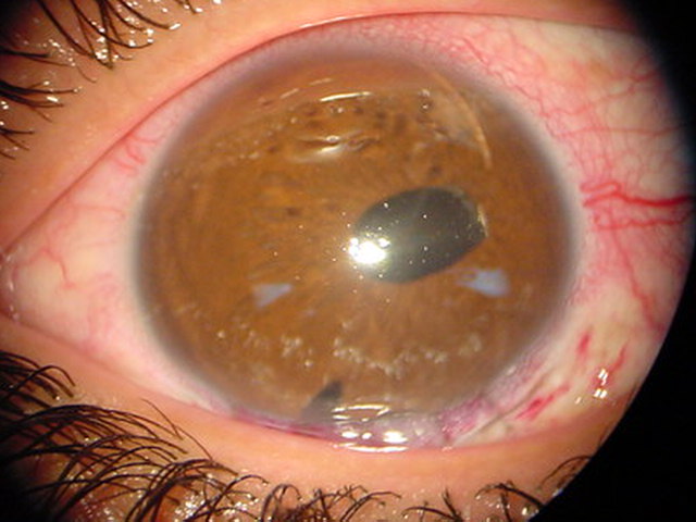Luxaci�n de hapteno del LIO a c�mara anterior