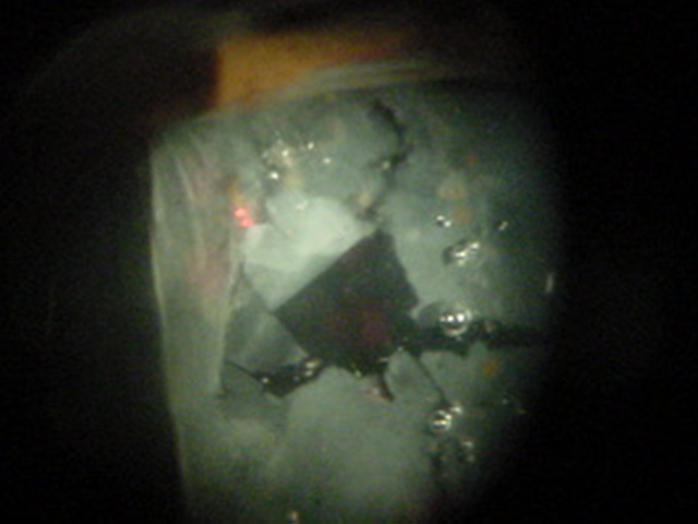 Capsulotom�a con YAG laser de catarata secundaria
