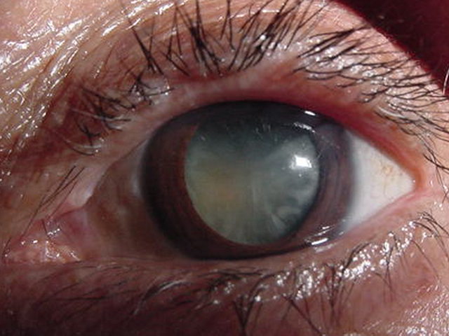 Catarata senil
