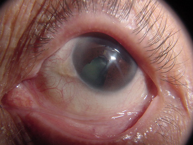 Coloboma t�pico de iris