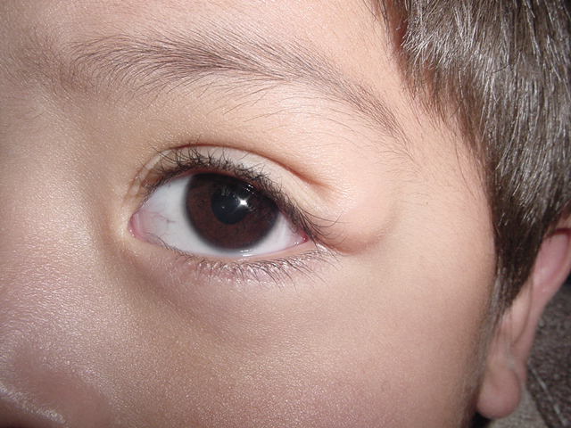 dermolipoma