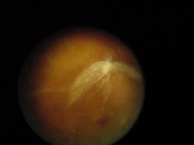 Banda fibrovascular en RDP