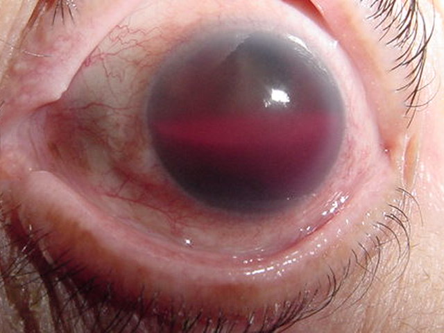 Hifema por neovasos en el segmento anterior en RDP