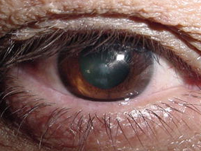 Nub�cula por hidrops corneal