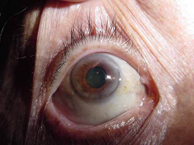 Pseudoexfoliaci�n capsular