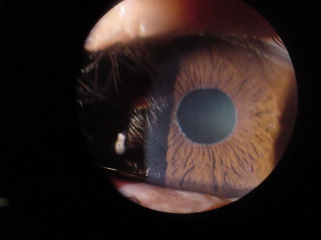Pseudoexfoliaci�n capsular en rodete pupilar