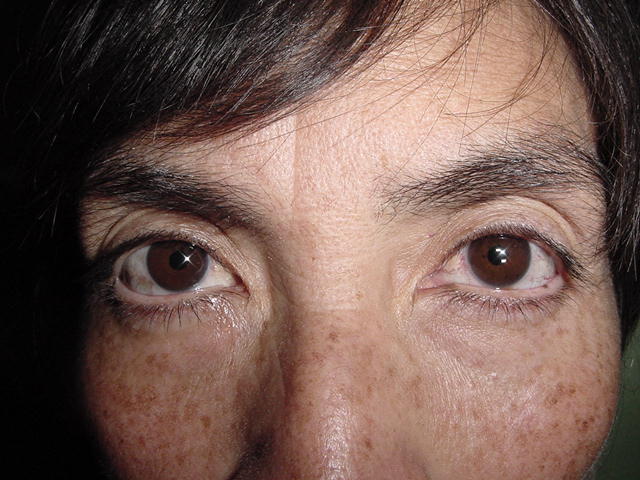 Pseudofaquia de ambos ojos de un a�o de evoluci�n