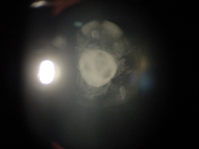 Catarata cong�nita