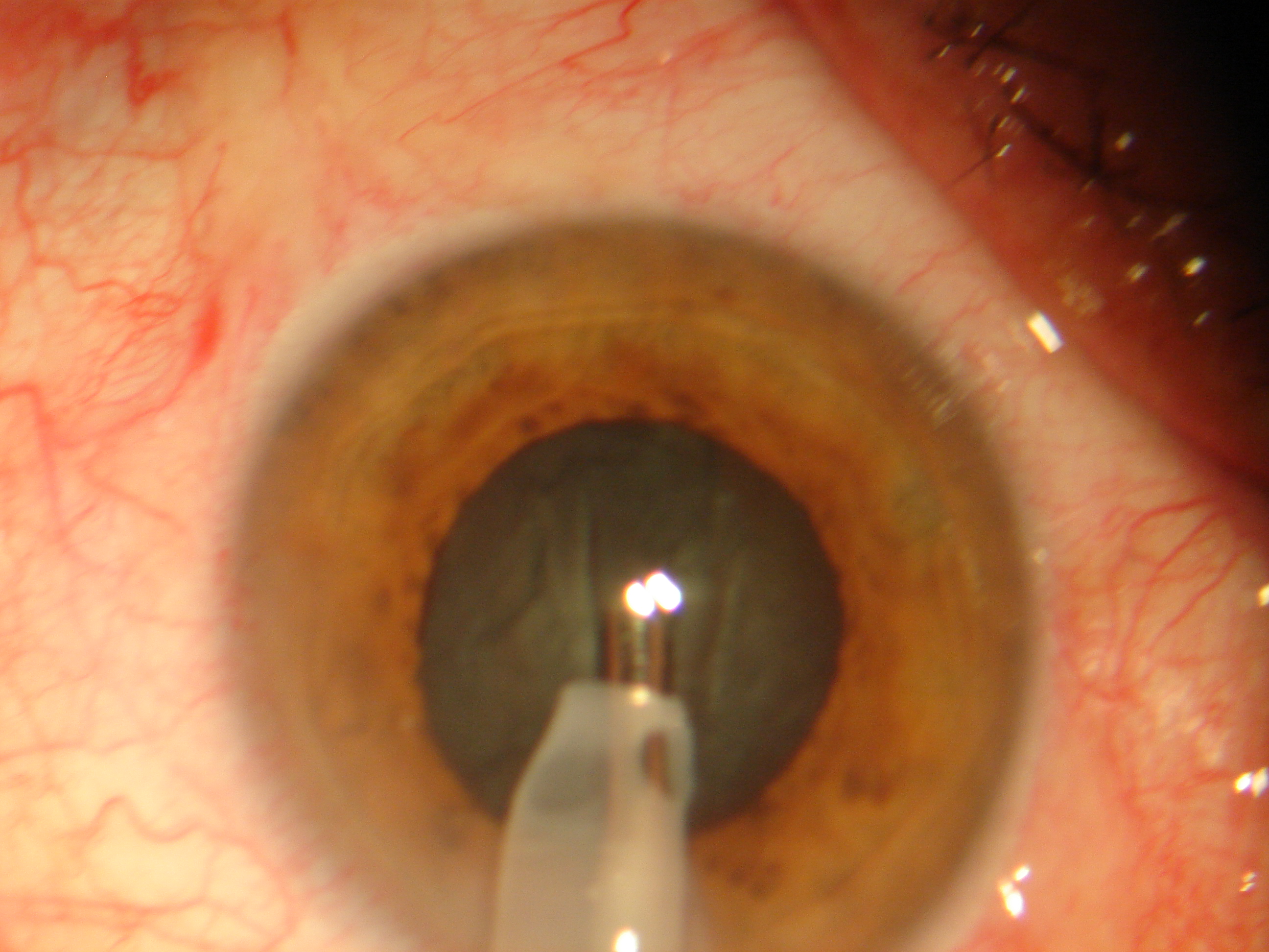 Facoemulsificaci�n
