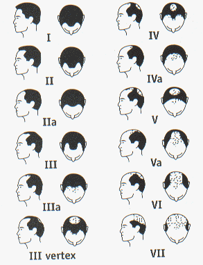 Tipos de alopecia