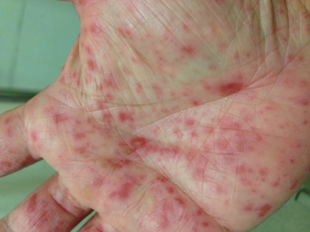 Rash up close