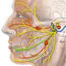 Facial Nerve Damaged Treatment Cure, Bell Palsy Herbal Medicine Treatment Cure KL Kuala Lumpur Medical Centre