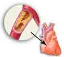 Heart Attack Herbal Herbs Treatment Cure KL Kuala Lumpur Medical Centre
