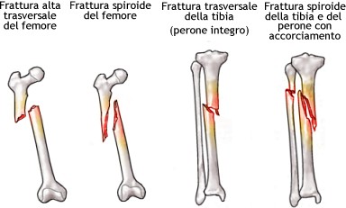 Fratture di femore e tibia