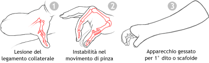 Lesione del legamento collaterale del 1� dito