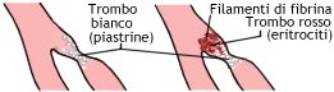 Accumulo di piastrine e filamenti di fibrina