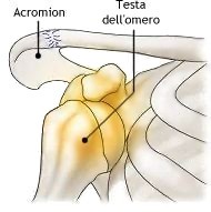 Lussazione sottocoracoidea