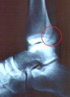 Notice the break extends fully to the end of the fibula