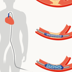 Cardiology patient ed