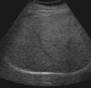 Fatty liver