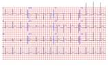 EKG admission