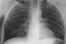 NormalCXR(Large)