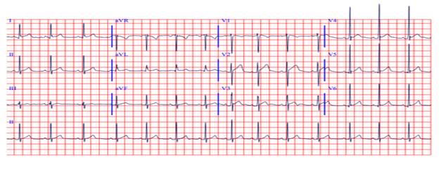 EKG admission