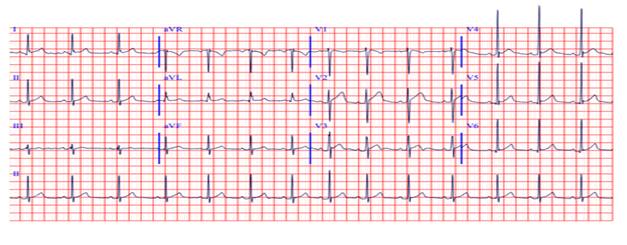 EKG admission