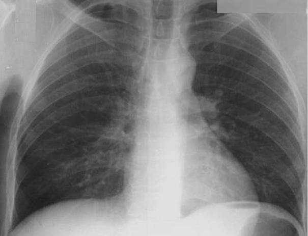 NormalCXR(Large)