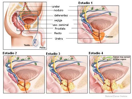 prostatectomía radical abierta técnica quirúrgica plante prostate epilobe
