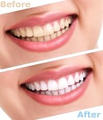 whiten teeth at home with hydrogen peroxide