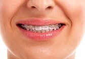 whiten teeth at home safely