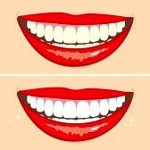 whitening teeth with peroxide safe