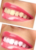 whiten teeth with braces at home