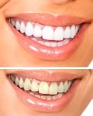 advantages of teeth whitening strips