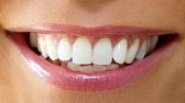groupon zoom teeth whitening melbourne
