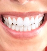 teeth laser whitening cost