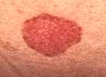 Skin cancer