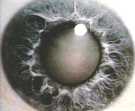 The whitened lens of cataract