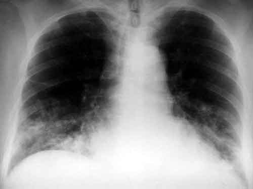 neumonia bilateral basal