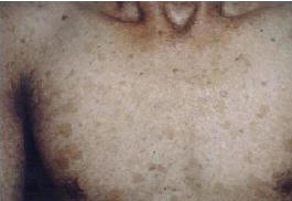 Cambios en la piel poililodermatosa en una paciente con síndrome de Kindler.