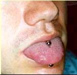 Endocarditis Bacteriana luego de Piercing en la lengua