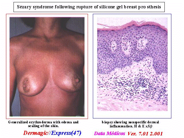 Sézary syndrome following rupture of silicone gel breast prosthesis Síndrome de Sézary tras rotura de prótesis mamaria de gel de silicona